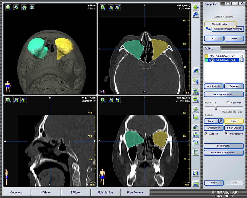 眼窩骨折の治療に3Dデジタル技術を導入 : VISITKOREA