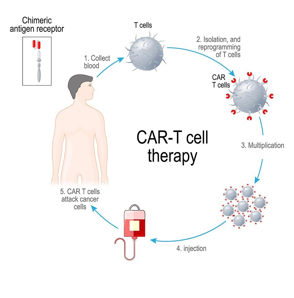 CAR-T cell therapy process 